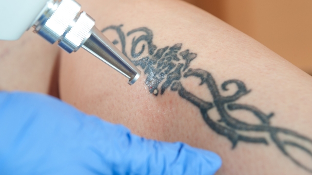 How Are You Able To Remove A Tattoo Safely?