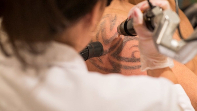 Feelings Do Not Last Forever So Tattoo Removal Is Often A Option