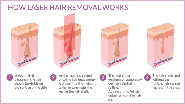 Smooth and Sleek: Unveiling the Magic of Laser Hair Removal