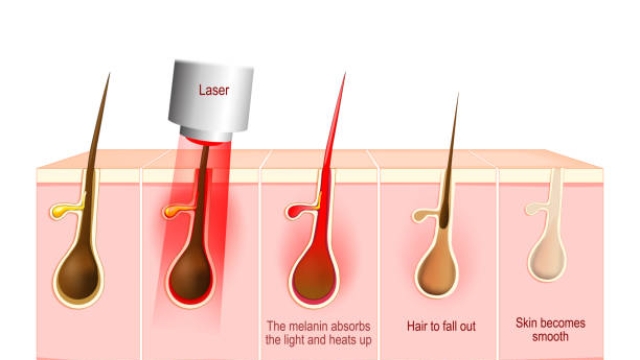 Laser Hair Removal: Unveiling the Smooth-Skin Secrets!